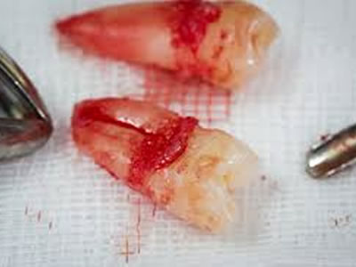 Dental Extrations